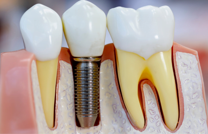 Implant procedure in diagnopein